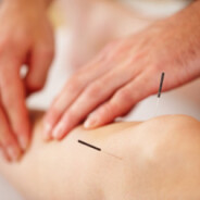 What can acupuncture treat?